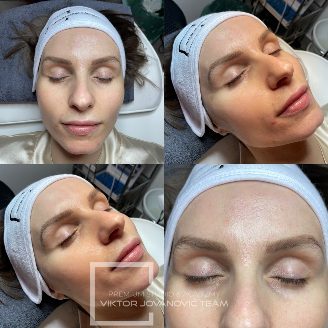 RF - lice - BEAUTY CENTER Viktor Jovanović, Subotica Tretman lica Lice Tretman lica, Subotica, Centar
