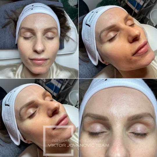 BEAUTY CENTER Viktor Jovanović #subotica Tretman lica RF - lice