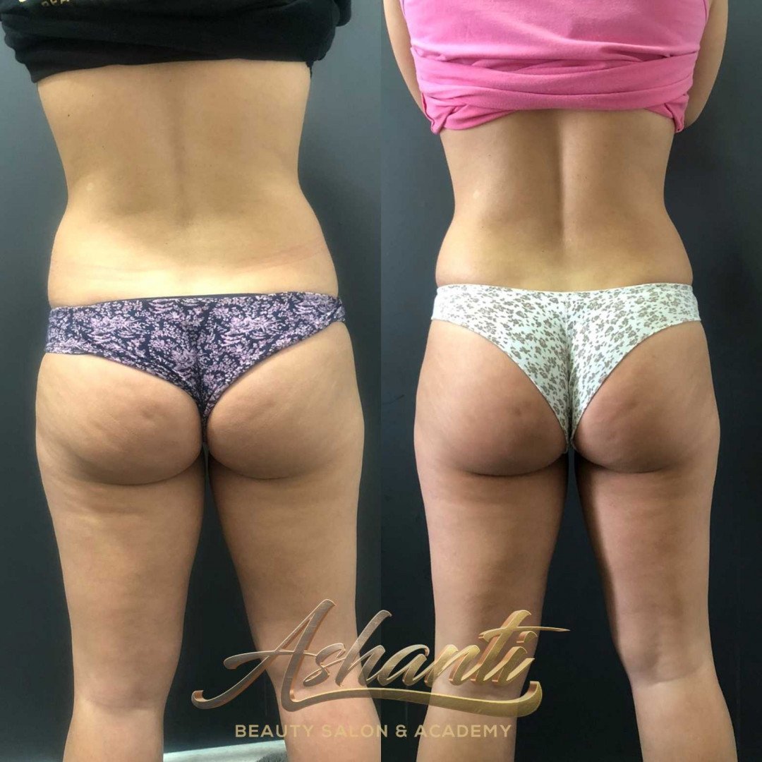 Ashanti Beauty Salon & Academy #beograd Tretmani tela Ice Body Sculpting