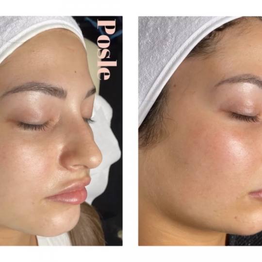 Zen Beauty #nis Hijaluronski tretmani lica Zen beauty Filler tretman
