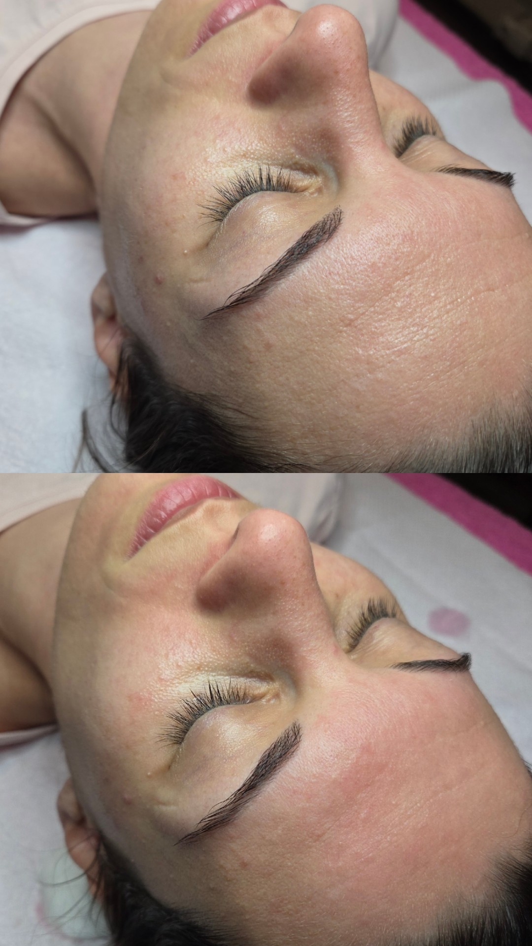 Starmedic #beograd Dermaroler i dermapen Holivudski sjaj - Jessner