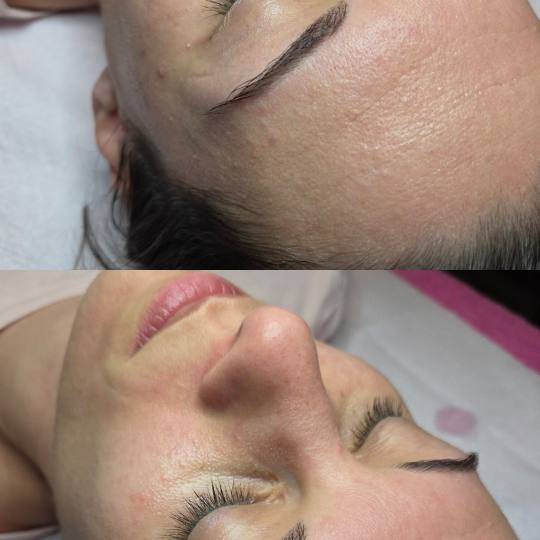 Starmedic #beograd Dermaroler i dermapen Holivudski sjaj - Jessner