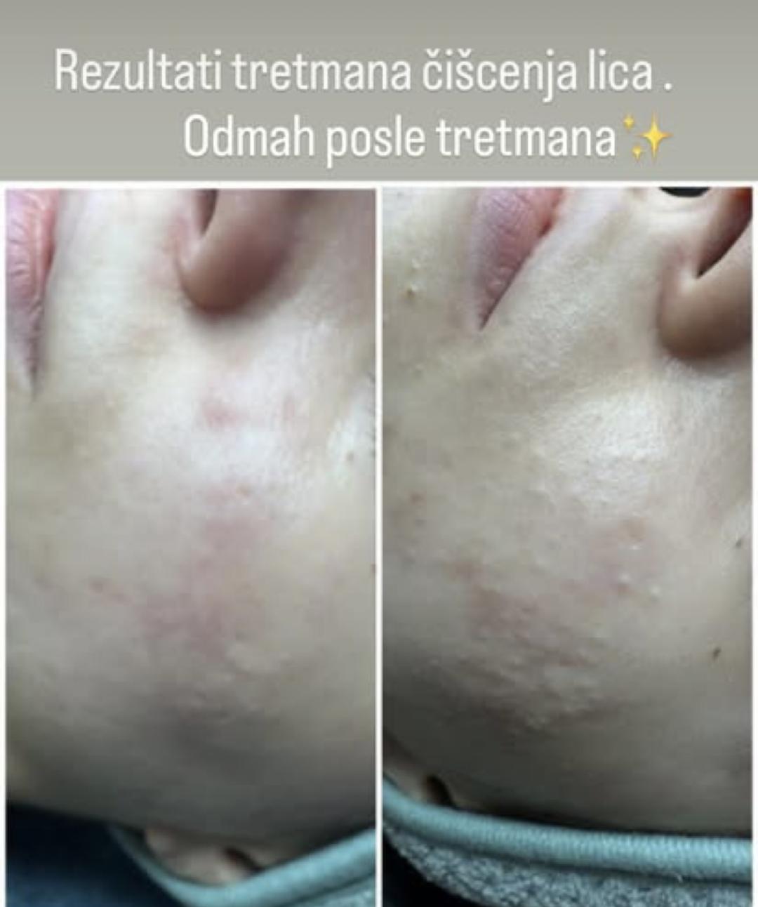 Mladalački tretman čišćenja lica - Petra beauty concept, Beograd Tretman lica Lice Tretman lica, Beograd, Vračar, Čubura, Crveni krst