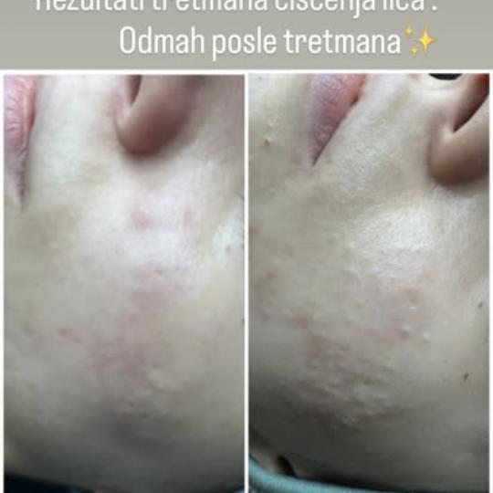 Petra beauty concept #beograd Tretman lica Mladalački tretman čišćenja lica Tretman započinje a