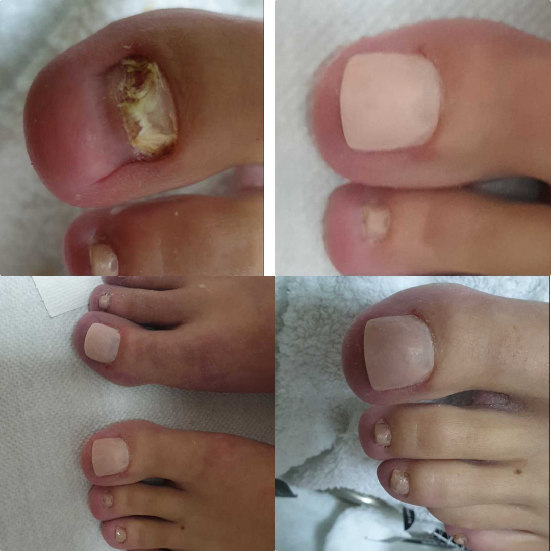 Tina B #beograd Medicinski pedikir Medicinski pedikir - gljivični / oboleli nokti