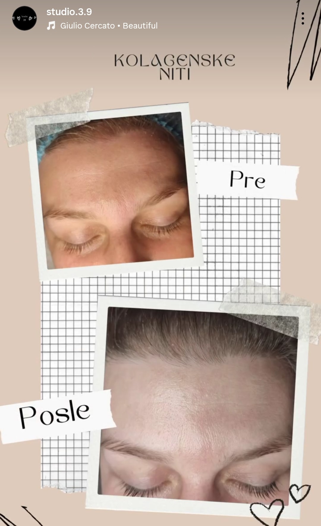 Studio 39 #beograd Tretman lica Kolagen niti - lice