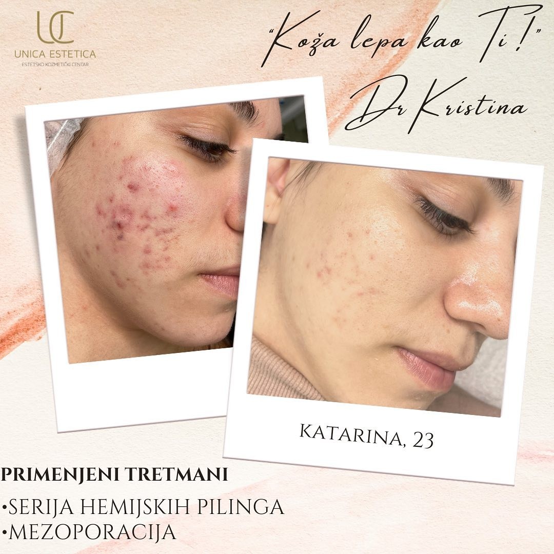 Unica Estetica #nis Tretman lica Hemijski piling azelaičnom kiselinom