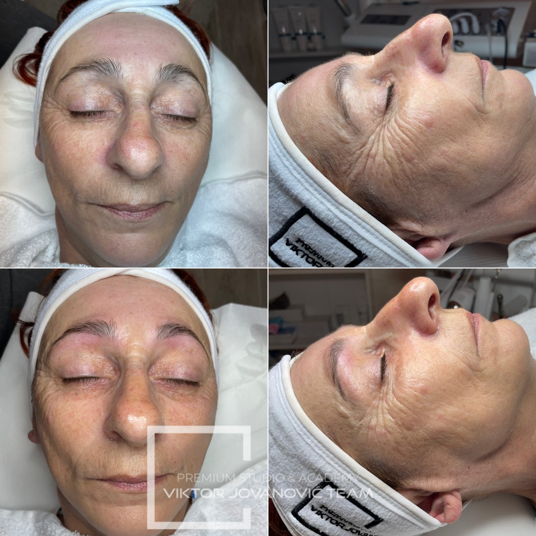 Higijenski tretman lica + RF - BEAUTY CENTER Viktor Jovanović, Subotica Tretman lica Lice Tretman lica, Subotica, Centar