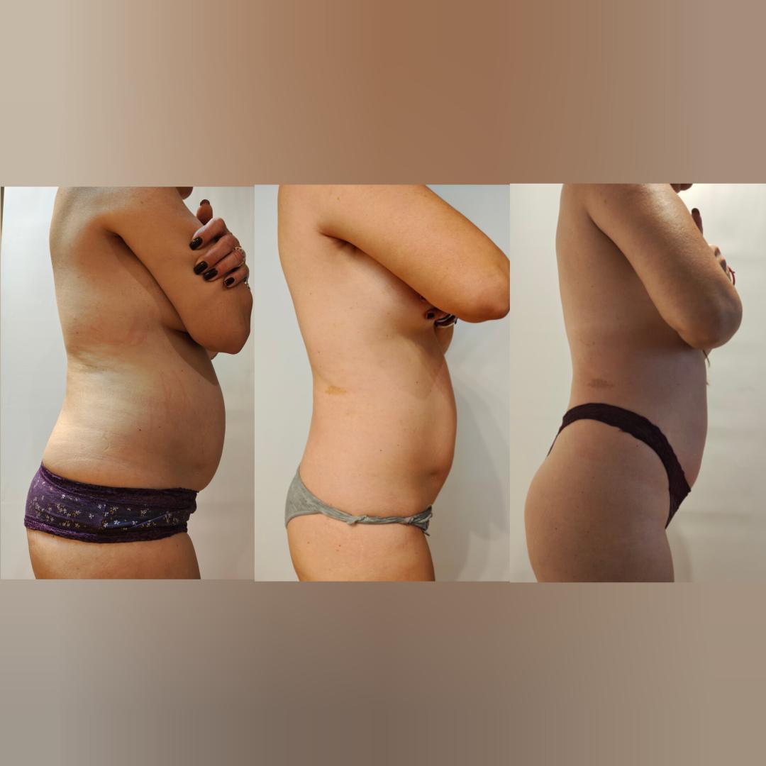 Apolona #beograd Lipomodelovanje Body shaping PRO - po regiji