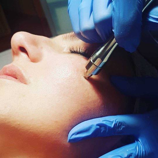 Unna Centar #beograd Mikrodermoabrazija #cista #sjajna koza Mikrodermoabrazija