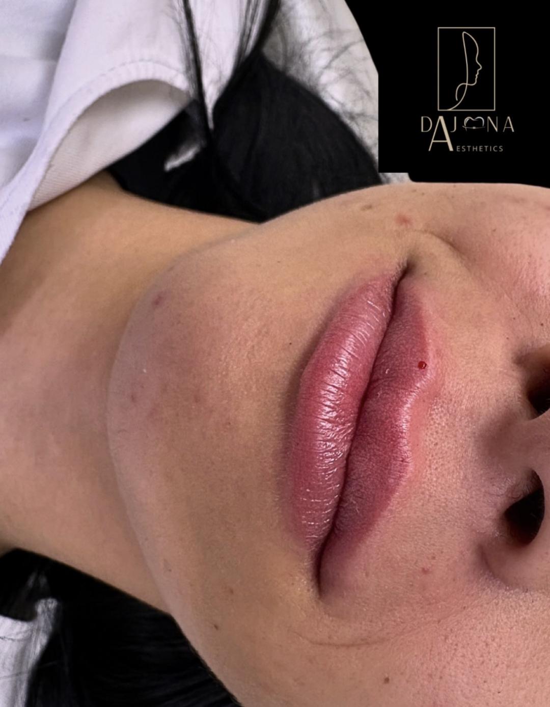 Korekcija usana -1ml Radiant filera - DajanaAesthetics, Novi Sad Dermalni fileri Lice Dermalni fileri, Novi Sad, Grbavica, Liman, Adamićevo naselje