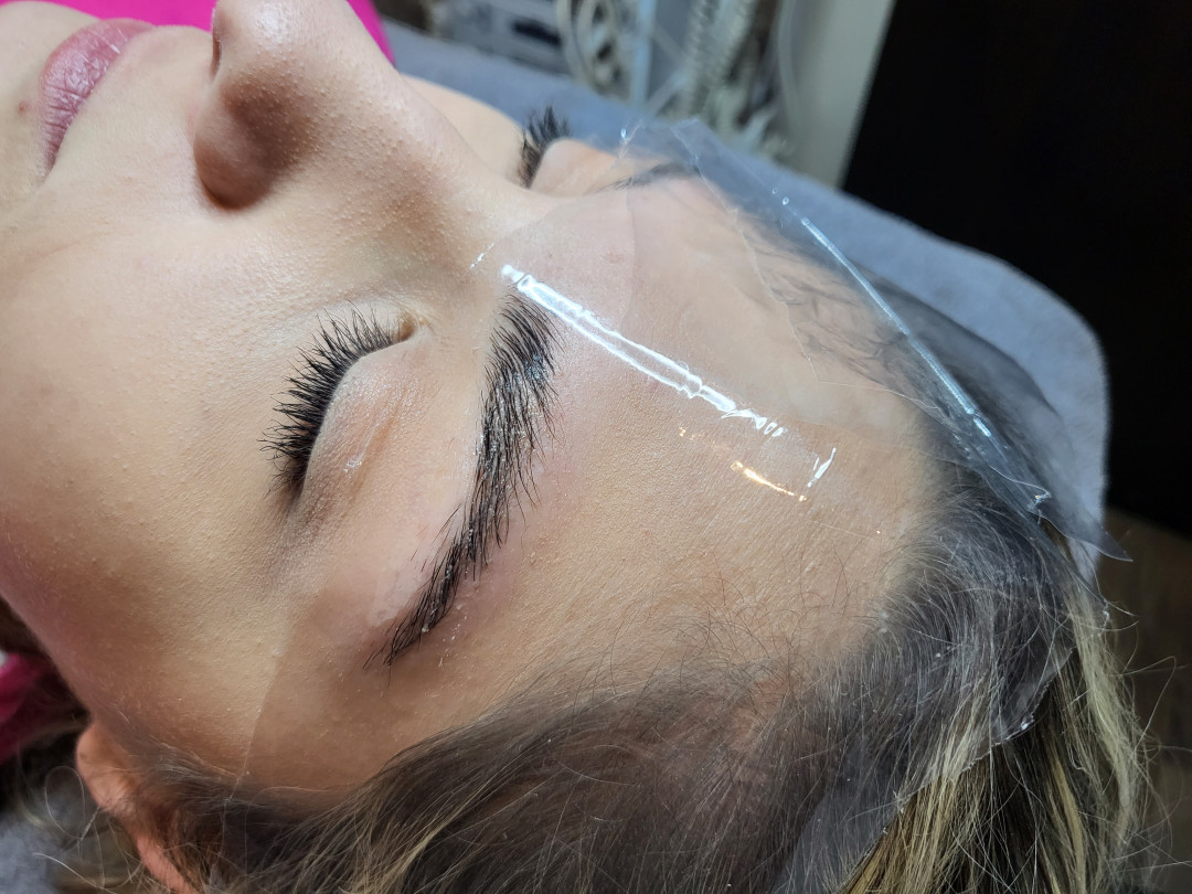 Brow lift - Starmedic, Beograd Trepavice Lice Trepavice, Beograd, Vračar, Čubura, Crveni krst