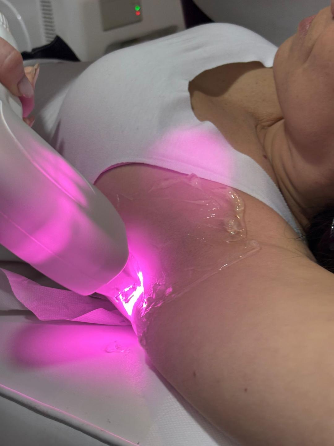 Angels #novisad Laserska epilacija Laserska epilacija pazuha - za dame