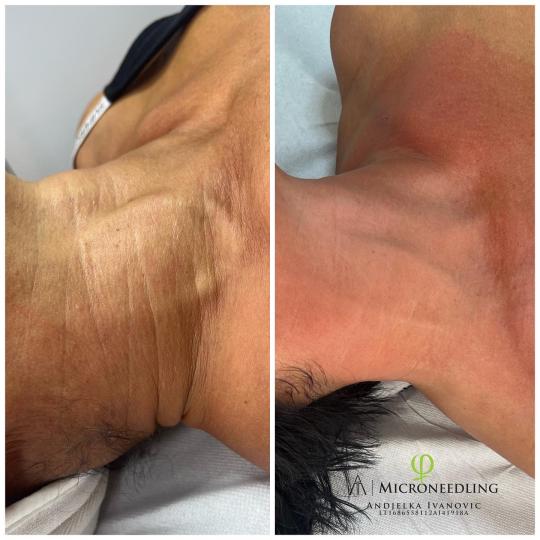 Belle Ana #beograd Tretmani vrata i dekoltea Microneedling tretman - vrat + dekolte