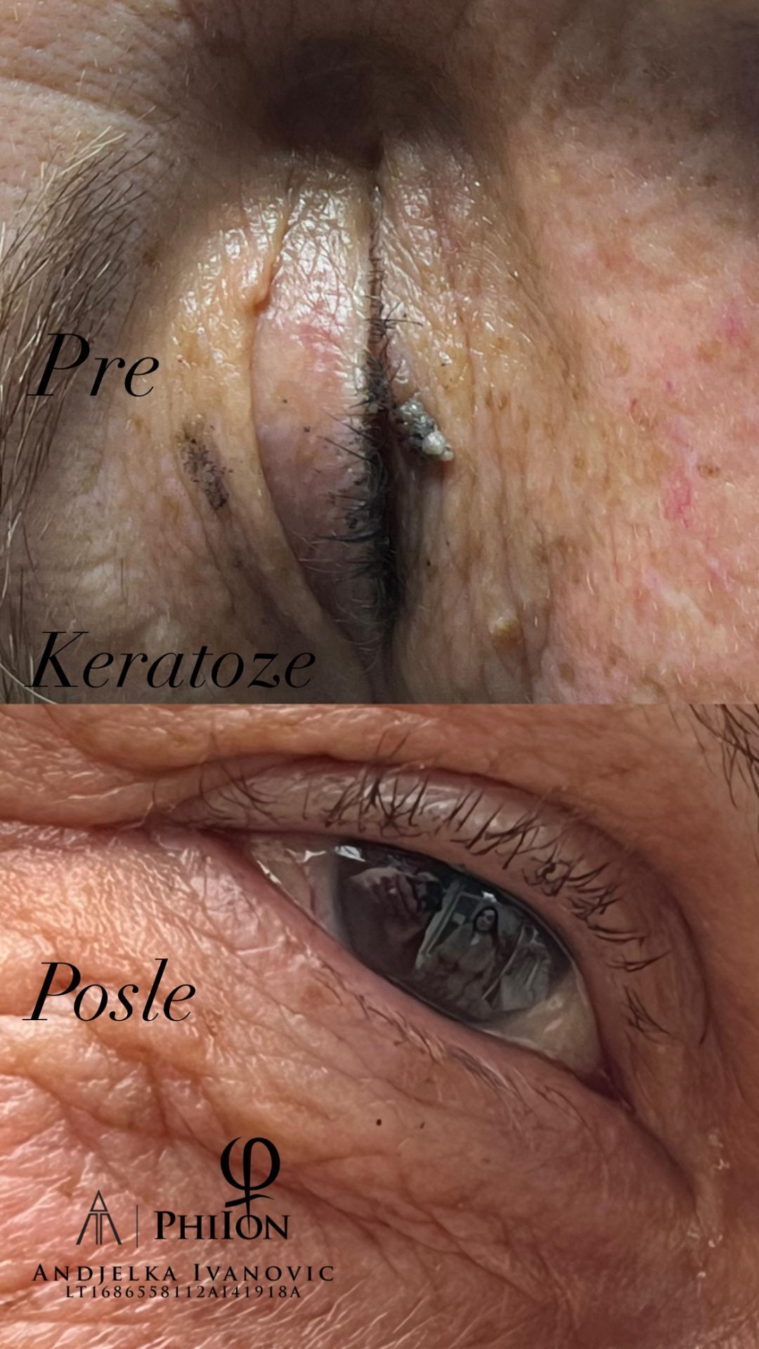 Belle Ana #beograd Tretman lica Phi-Ion tretman - bradavice / papilomi / keratoze / milije / hiperpigmentacija