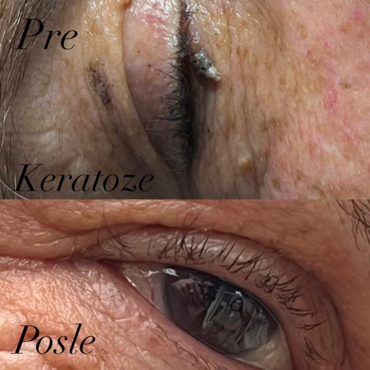 Belle Ana #beograd Tretman lica Phi-Ion tretman - bradavice / papilomi / keratoze / milije / hiperpi