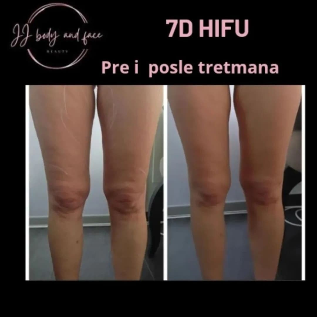 Beauty by Sanja #novisad Tretmani tela Hifu tretman - noge