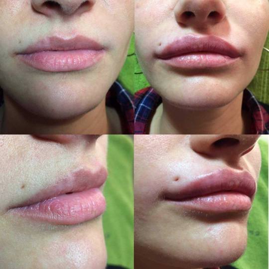 Womanizer #beograd Kozmetički doktori punjenje usana biopolimerom!! pre i posle Popunjavanje usana 