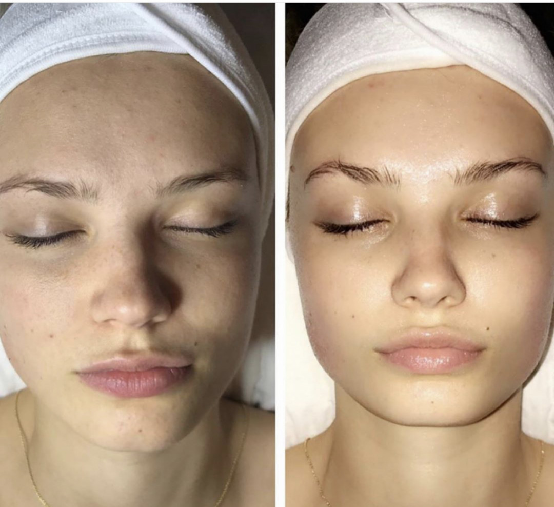 SkinLab Beauty Centar #novisad Tretman lica SKINLUX