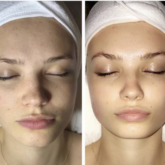 SkinLab Beauty Centar #novisad Tretman lica SKINLUX