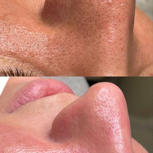 L’Avenue #beograd Tretman lica Higijenski tretman lica