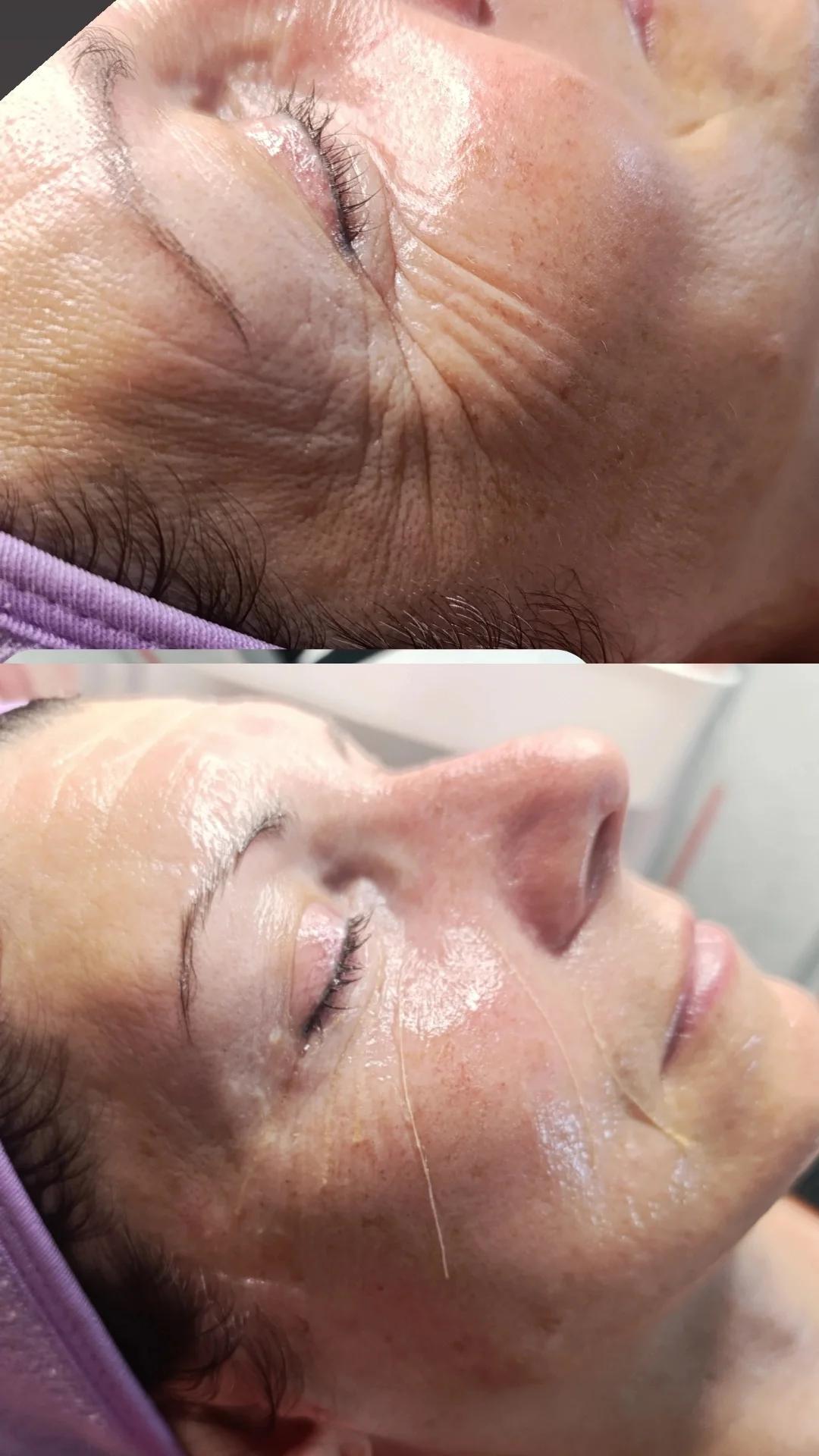 Ceragem Relax #krusevac Tretman lica Kolagen niti - lice + vrat