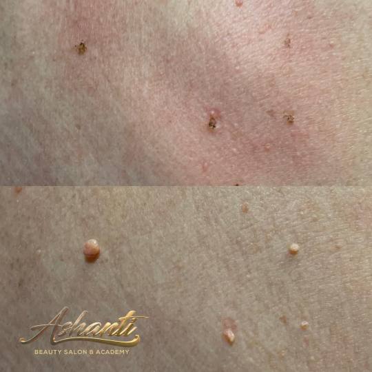 Ashanti Beauty Salon & Academy #beograd Tretman lica Plasma pen - skidanje do 10 bradavica