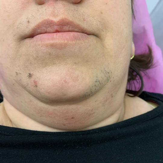 Body Beauty Balance 2020 #beograd Laserska epilacija