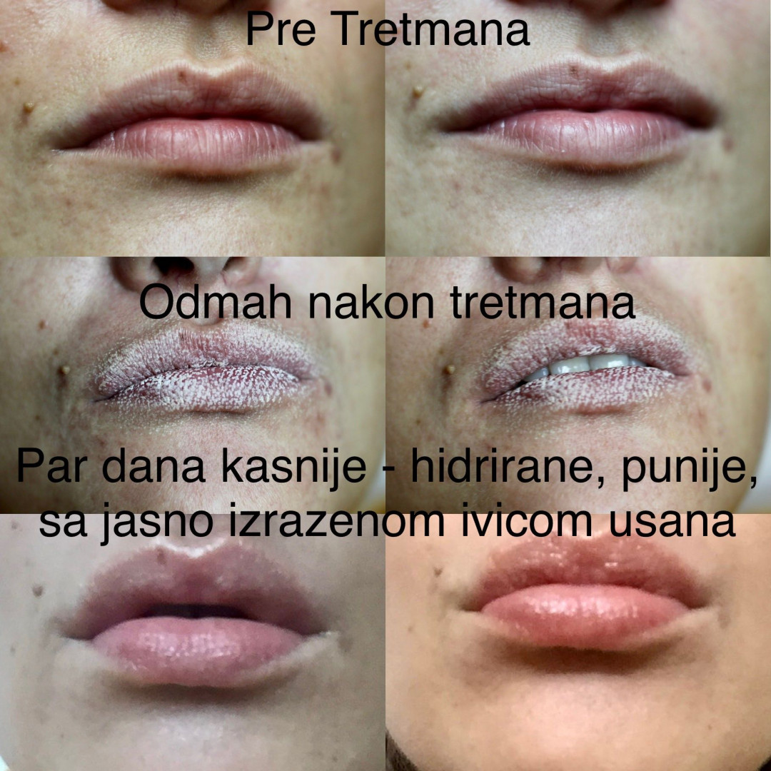 Poliklinika Marić #novisad Tretman lica Laserski tretman usana - rejuvenacija