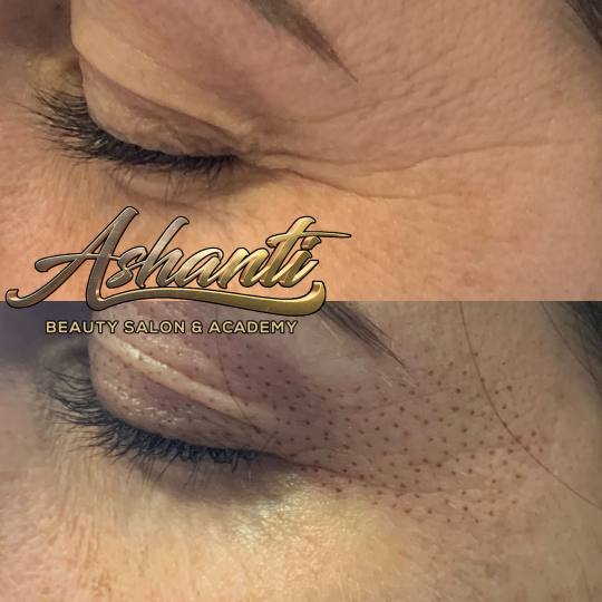 Ashanti Beauty Salon & Academy #beograd Tretman lica Plasma pen - gornji kapci