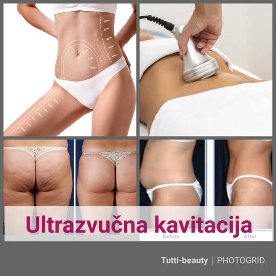 Tutti Beauty #beograd Ultrazvučna kavitacija- liposukcija