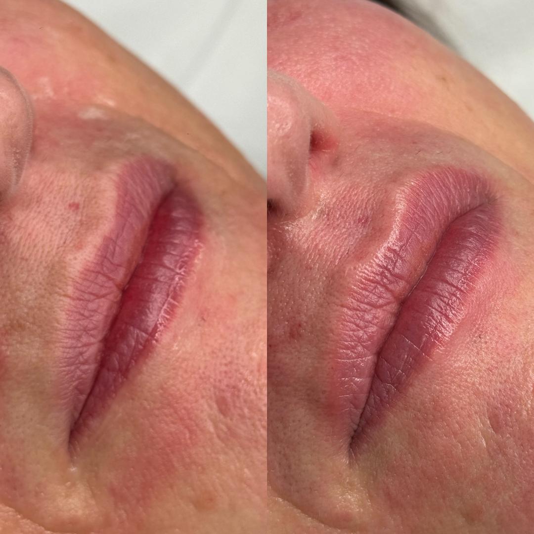 L’Avenue #beograd Mezoterapija lica Hydralips-mezoterapija usana hijaluronom