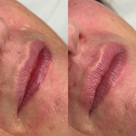 L’Avenue #beograd Mezoterapija lica Hydralips-mezoterapija usana hijaluronom