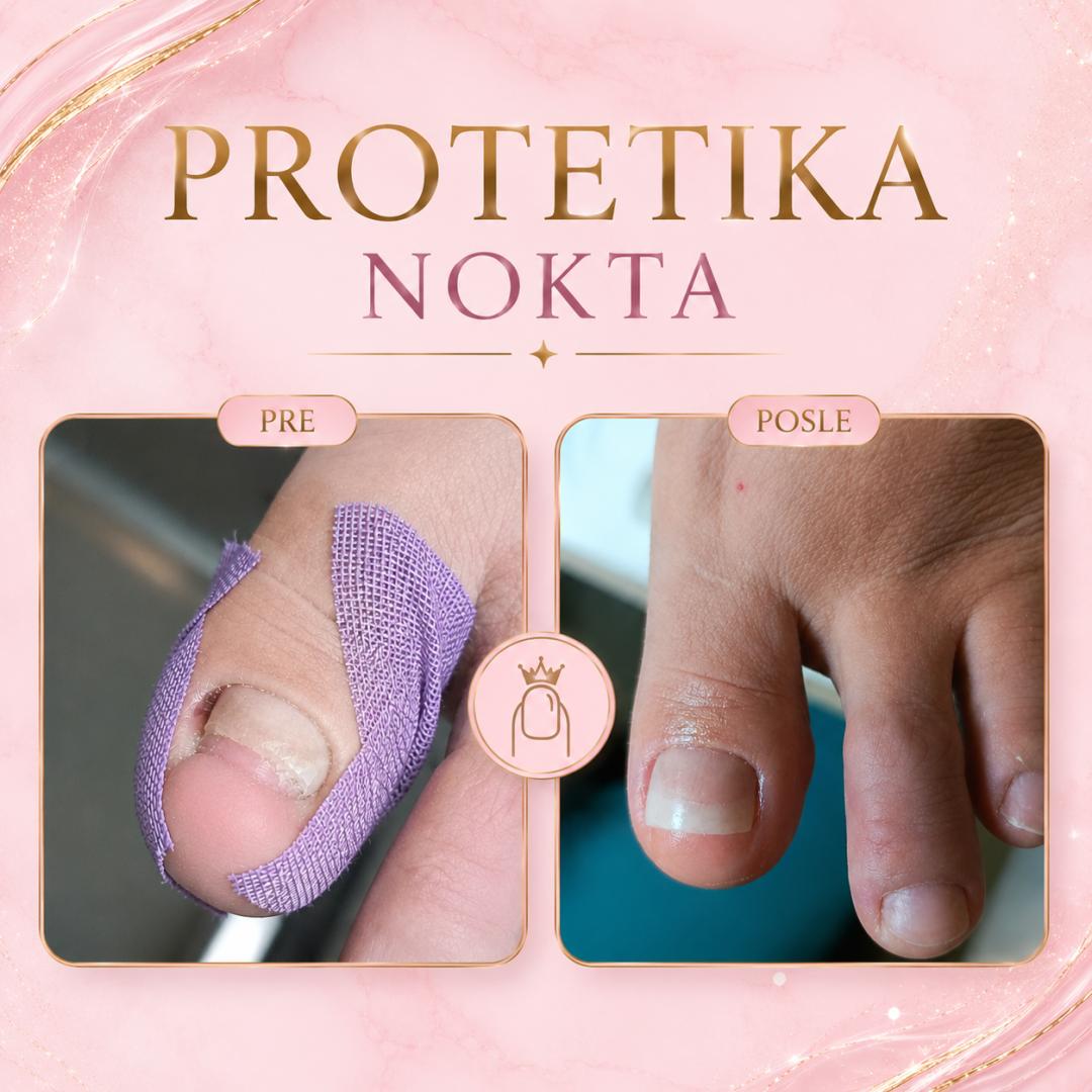 PROTETIKA JEDNOG NOKTA - Fenix, Beograd Manikir Nokti Manikir, Beograd, Dušanovac, Šumice