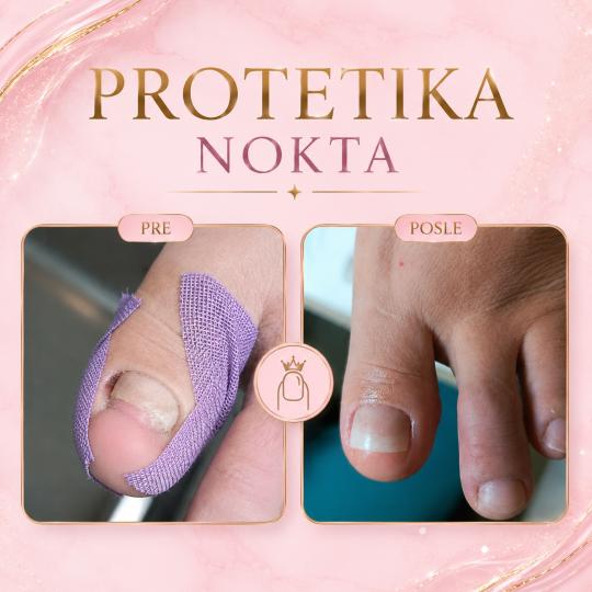 Fenix #beograd Manikir PROTETIKA JEDNOG NOKTA ✨ PROTETIKA NOKTA ✨
Protetika nokta je savremena 