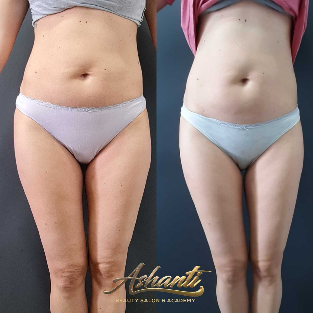 Ashanti Beauty Salon & Academy #beograd Masaža za mršavljenje Dermapen - regija lica