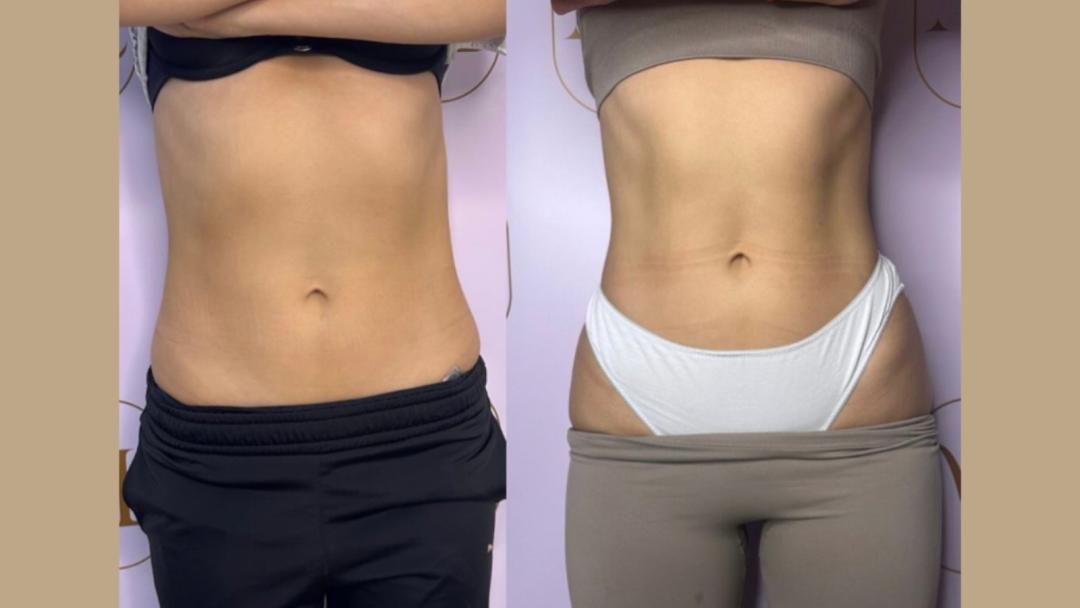 Personalizovani Attento tretmani tela - paket od 6 tretmana - Attento Aesthetic, Beograd Tretmani tela Telo Tretmani tela, Beograd, Zvezdara