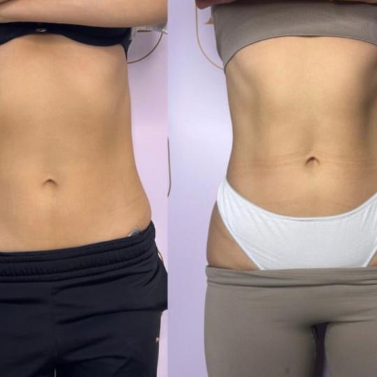 Attento Aesthetic #beograd Tretmani tela Personalizovani Attento tretmani tela - paket od 6 tretmana