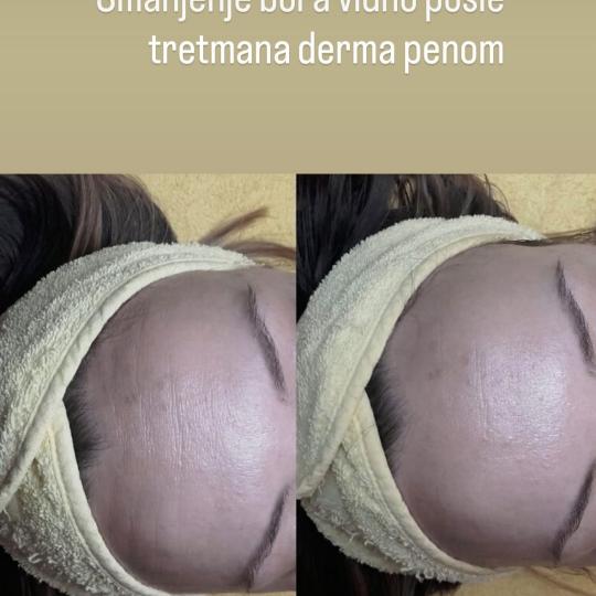 Petra beauty concept #beograd Dermaroler i dermapen Dermapen tretman lica