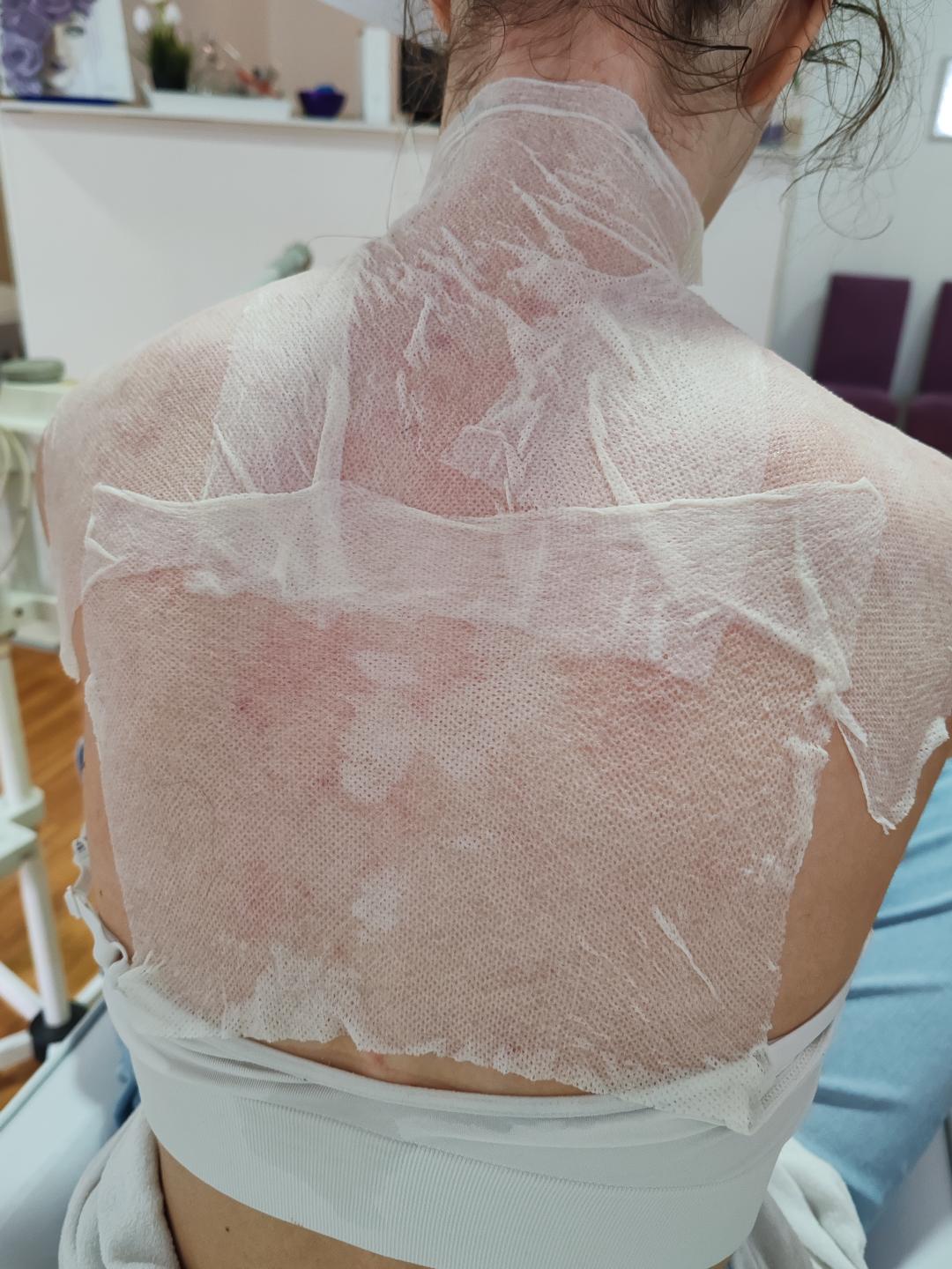 Dermapen tretman - leđa + ramena - Natural Beauty Lux, Beograd Mikrodermoabrazija Lice Mikrodermoabrazija, Beograd, Bežanijska kosa, Bežanija, Ledine, Surčin