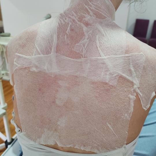 Natural Beauty Lux #beograd Mikrodermoabrazija Dermapen tretman - leđa + ramena Dermapen za leđa i