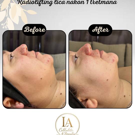 Lara Beauty 037 #krusevac Tretman lica Radiotalasni lifting lica - paket od 5 tretmana