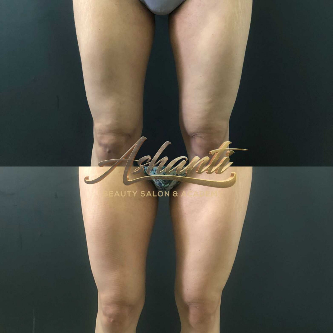 Ashanti Beauty Salon & Academy #beograd Tretmani tela Ice Body Sculpting