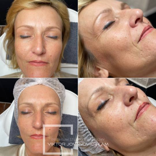 BEAUTY CENTER Viktor Jovanović #subotica Tretman lica Higijenski tretman lica