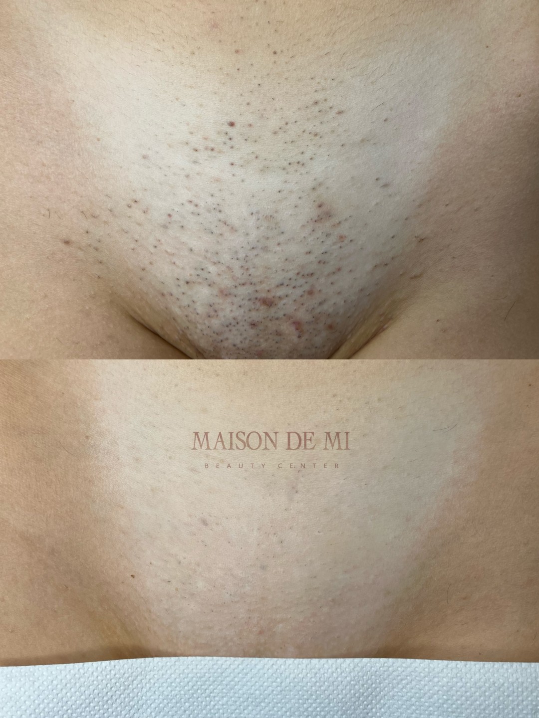 Maison de mi #beograd Laserska epilacija Laserska epilacija celih nogu + intimna regija - za dame