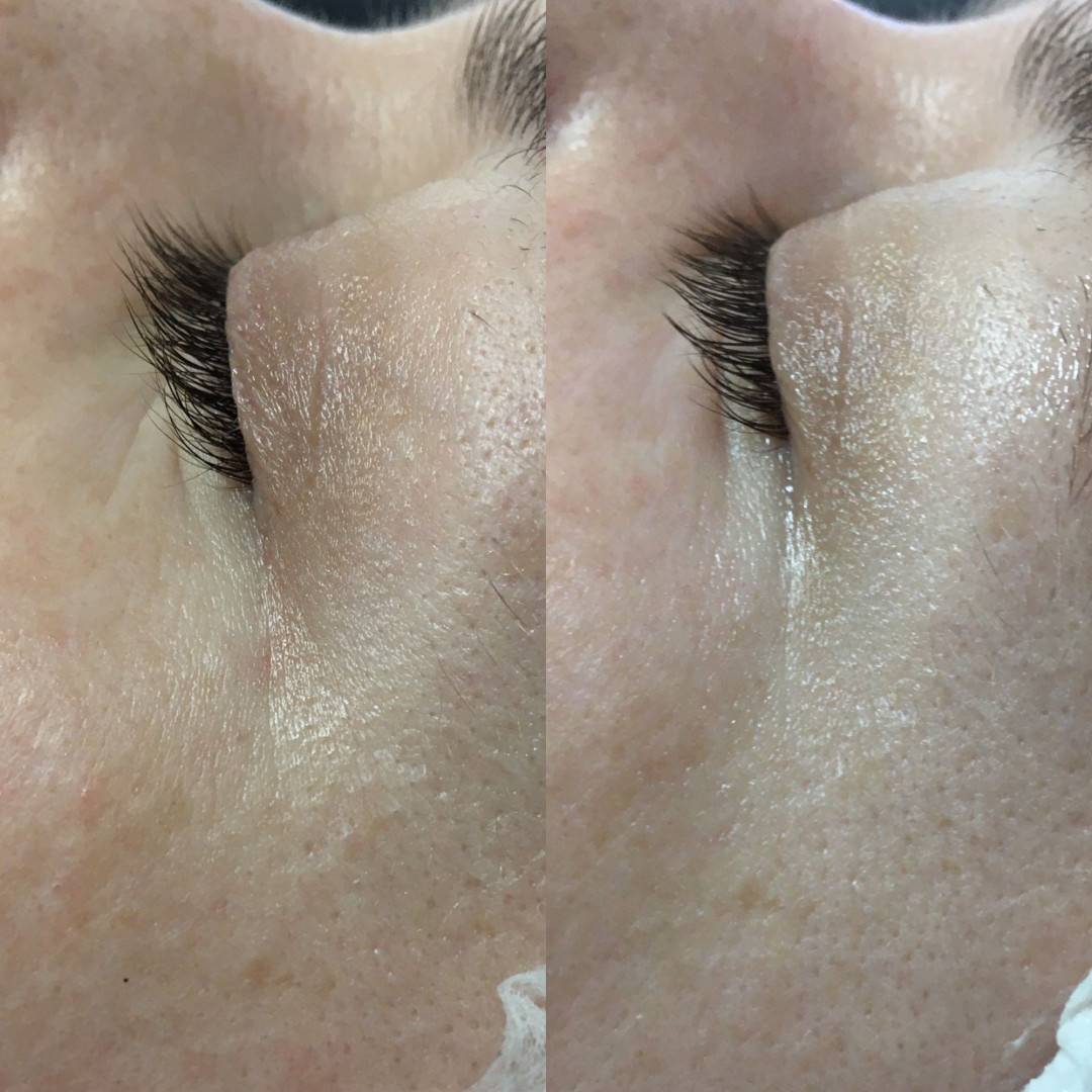 Look at me #beograd Tretmani protiv bora 3D Wrinkle tretman lica