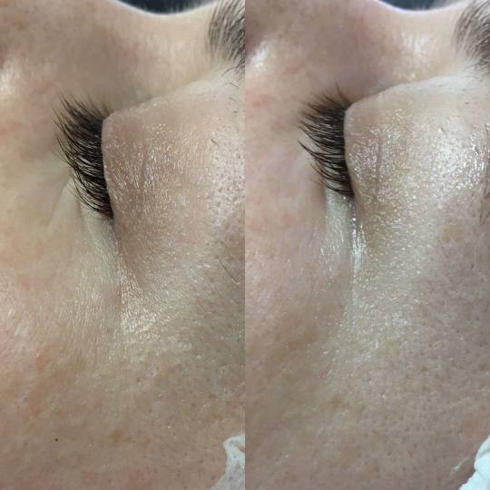 Look at me #beograd Tretmani protiv bora 3D Wrinkle tretman lica