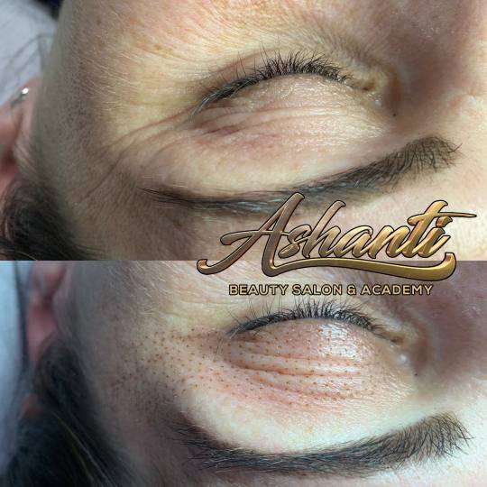 Ashanti Beauty Salon & Academy #beograd Tretman lica Plasma pen - gornji kapci