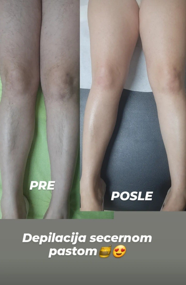 Lady NP #leskovac Depilacija šećernom pastom Depilacija celih nogu šećernom pastom - za dame