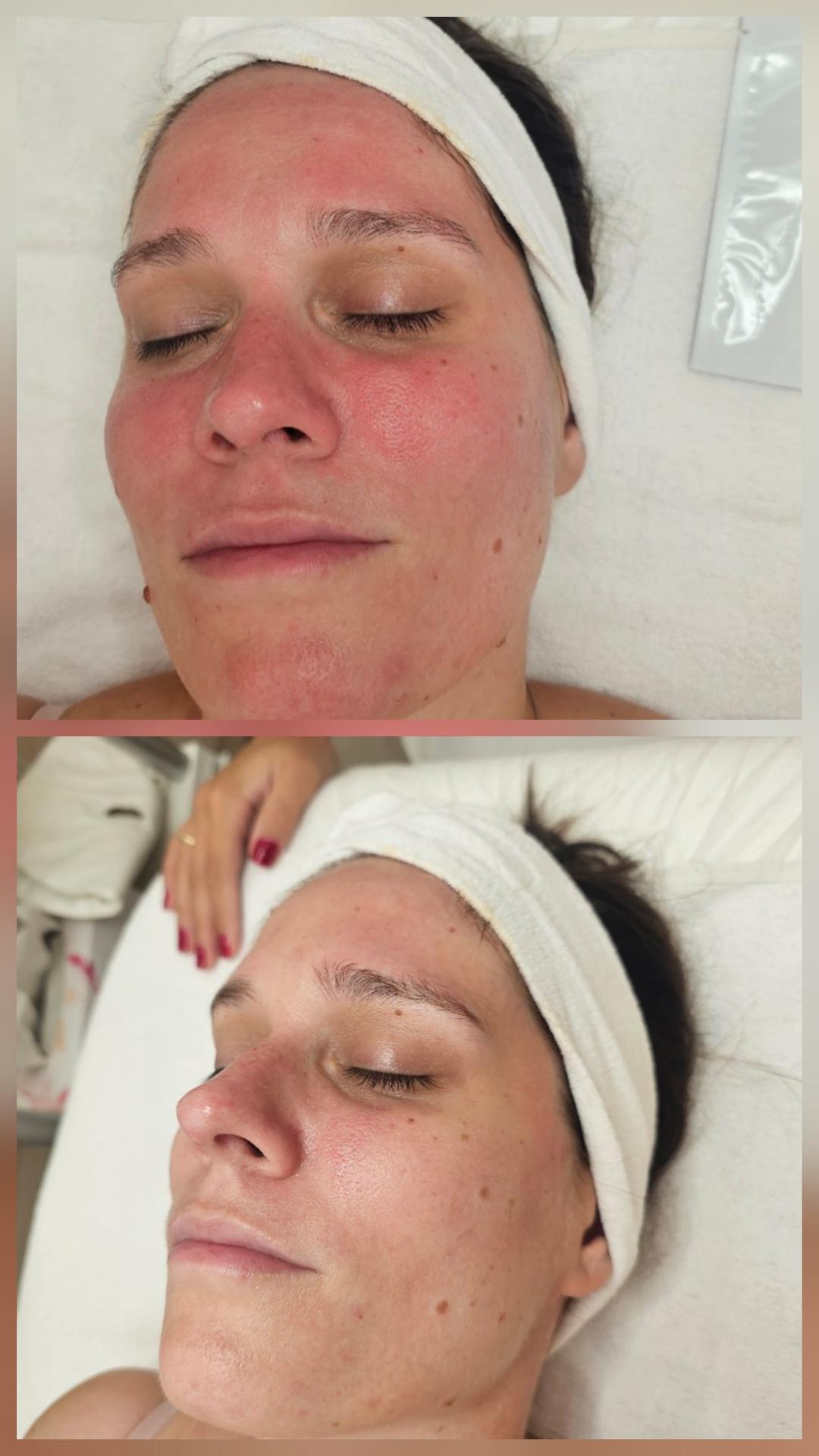 Microneedling tretman - Choco Love, Beograd Tretman lica Lice Tretman lica, Beograd, Vračar, Čubura, Crveni krst